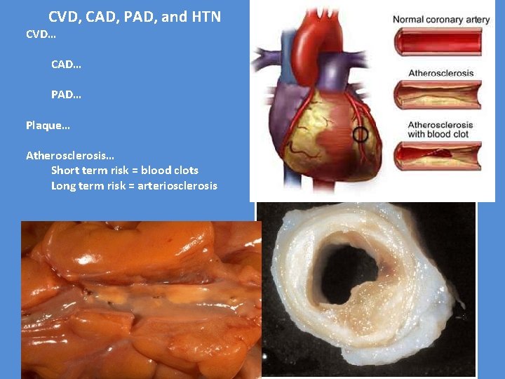 CVD, CAD, PAD, and HTN CVD… CAD… Plaque… Atherosclerosis… Short term risk = blood
