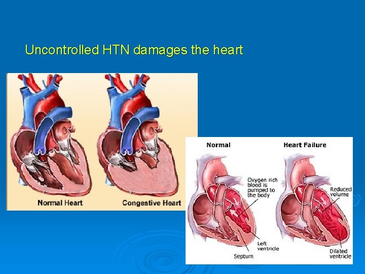 Uncontrolled HTN damages the heart 