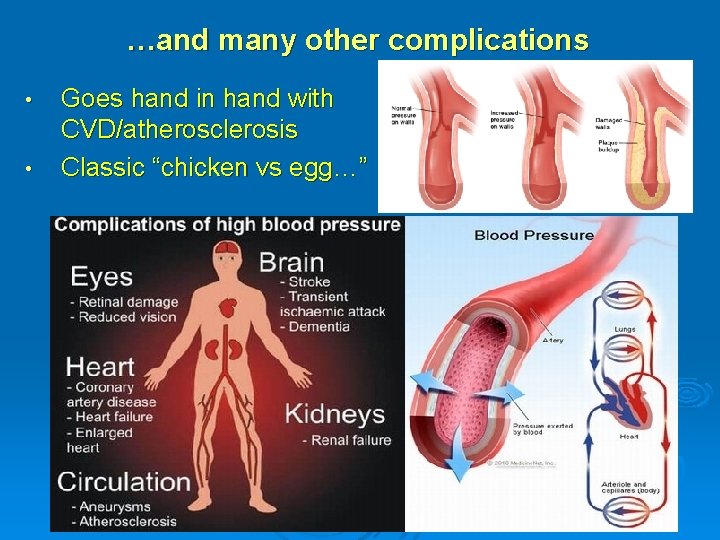 …and many other complications • • Goes hand in hand with CVD/atherosclerosis Classic “chicken
