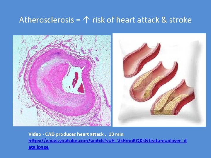 Atherosclerosis = ↑ risk of heart attack & stroke Video - CAD produces heart