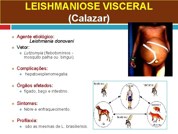LEISHMANIOSE VISCERAL (Calazar) v v Agente etiológico: Leishmania donovani Vetor: v v Complicações: v