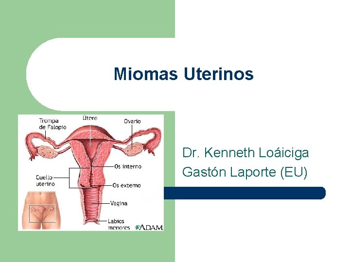 Miomas Uterinos Dr. Kenneth Loáiciga Gastón Laporte (EU) 