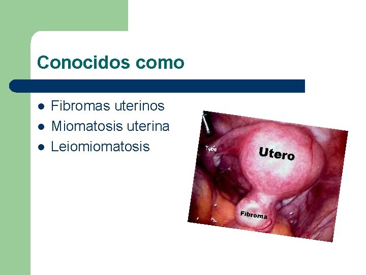 Conocidos como l l l Fibromas uterinos Miomatosis uterina Leiomiomatosis 