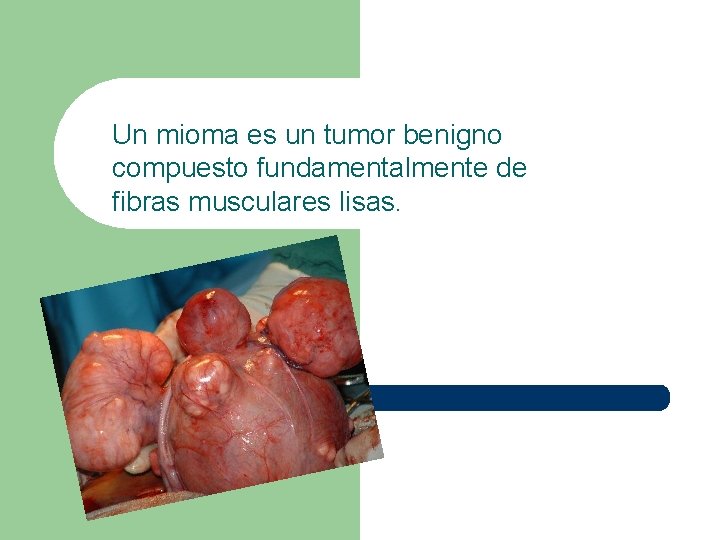 Un mioma es un tumor benigno compuesto fundamentalmente de fibras musculares lisas. 