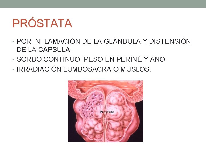 PRÓSTATA • POR INFLAMACIÓN DE LA GLÁNDULA Y DISTENSIÓN DE LA CAPSULA. • SORDO PRÓSTATA • POR INFLAMACIÓN DE LA GLÁNDULA Y DISTENSIÓN DE LA CAPSULA. • SORDO