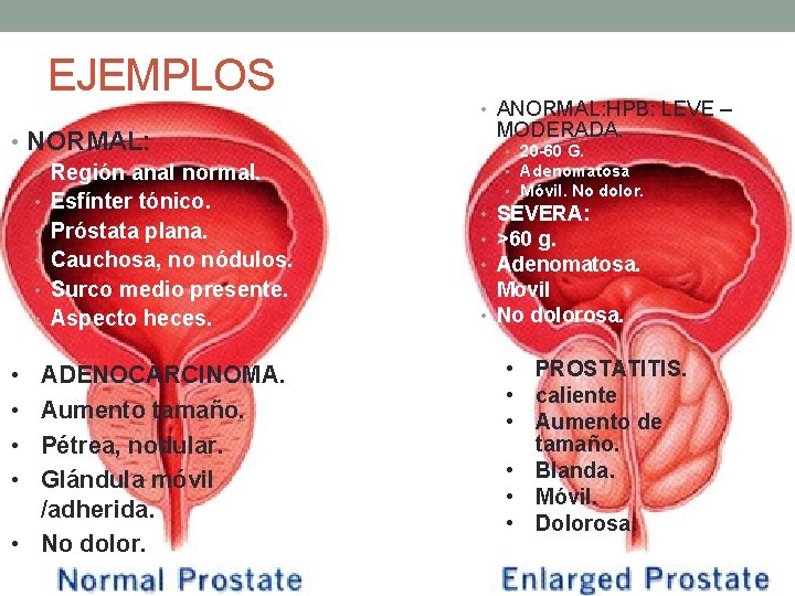 EJEMPLOS • NORMAL: • Región anal normal. • Esfínter tónico. • Próstata plana. • EJEMPLOS • NORMAL: • Región anal normal. • Esfínter tónico. • Próstata plana. •