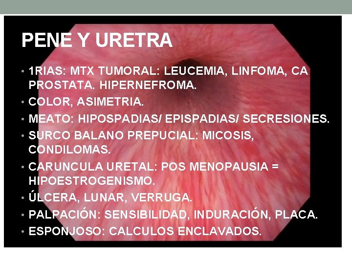 PENE Y URETRA • 1 RIAS: MTX TUMORAL: LEUCEMIA, LINFOMA, CA PROSTATA. HIPERNEFROMA. • PENE Y URETRA • 1 RIAS: MTX TUMORAL: LEUCEMIA, LINFOMA, CA PROSTATA. HIPERNEFROMA. •