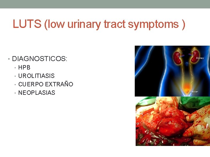 LUTS (low urinary tract symptoms ) • DIAGNOSTICOS: • HPB • UROLITIASIS • CUERPO LUTS (low urinary tract symptoms ) • DIAGNOSTICOS: • HPB • UROLITIASIS • CUERPO