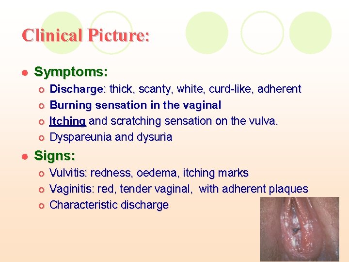 Clinical Picture: l Symptoms: ¡ ¡ l Discharge: thick, scanty, white, curd-like, adherent Burning Clinical Picture: l Symptoms: ¡ ¡ l Discharge: thick, scanty, white, curd-like, adherent Burning