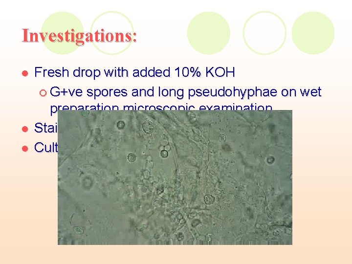 Investigations: l l l Fresh drop with added 10% KOH ¡ G+ve spores and Investigations: l l l Fresh drop with added 10% KOH ¡ G+ve spores and
