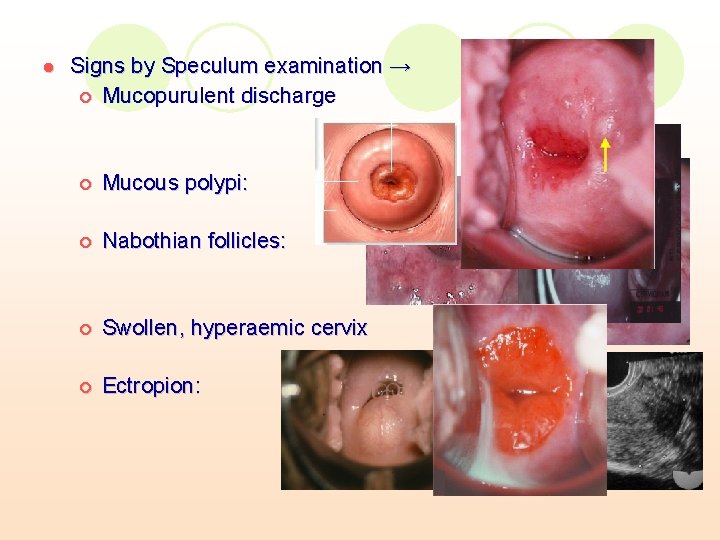 l Signs by Speculum examination → ¡ Mucopurulent discharge ¡ Mucous polypi: ¡ Nabothian l Signs by Speculum examination → ¡ Mucopurulent discharge ¡ Mucous polypi: ¡ Nabothian