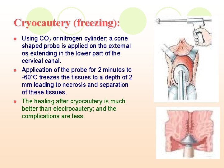 Cryocautery (freezing): l l l Using CO 2 or nitrogen cylinder; a cone shaped Cryocautery (freezing): l l l Using CO 2 or nitrogen cylinder; a cone shaped