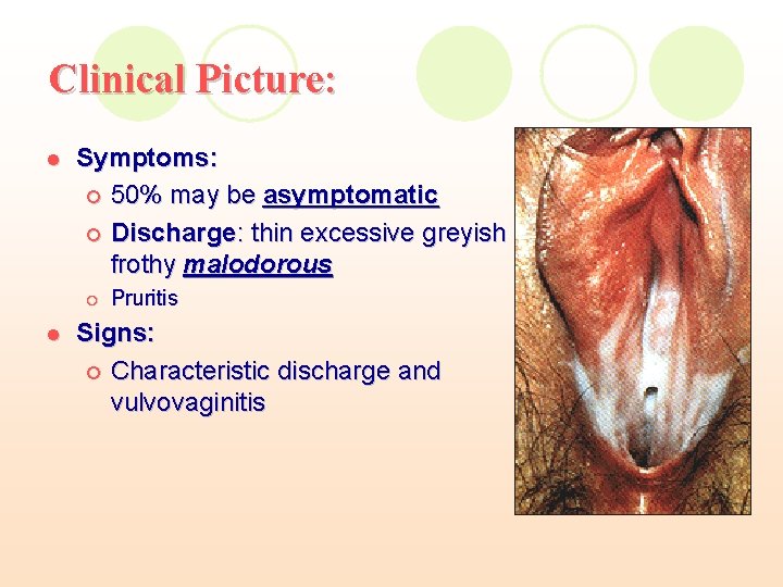 Clinical Picture: l Symptoms: ¡ 50% may be asymptomatic ¡ Discharge: thin excessive greyish Clinical Picture: l Symptoms: ¡ 50% may be asymptomatic ¡ Discharge: thin excessive greyish