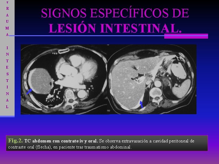 T R A U M A SIGNOS ESPECÍFICOS DE LESIÓN INTESTINAL. I N T