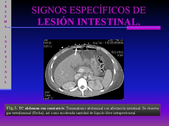 T R A U M A SIGNOS ESPECÍFICOS DE LESIÓN INTESTINAL. I N T