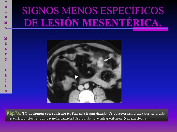 T R A U M A SIGNOS MENOS ESPECÍFICOS DE LESIÓN MESENTÉRICA. M E