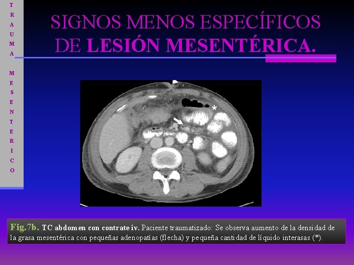 T R A U M A SIGNOS MENOS ESPECÍFICOS DE LESIÓN MESENTÉRICA. M E