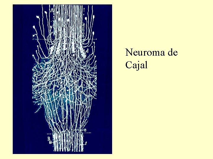 Neuroma de Cajal 