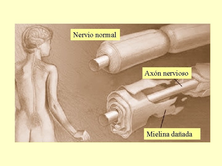 Nervio normal Axón nervioso Mielina dañada 