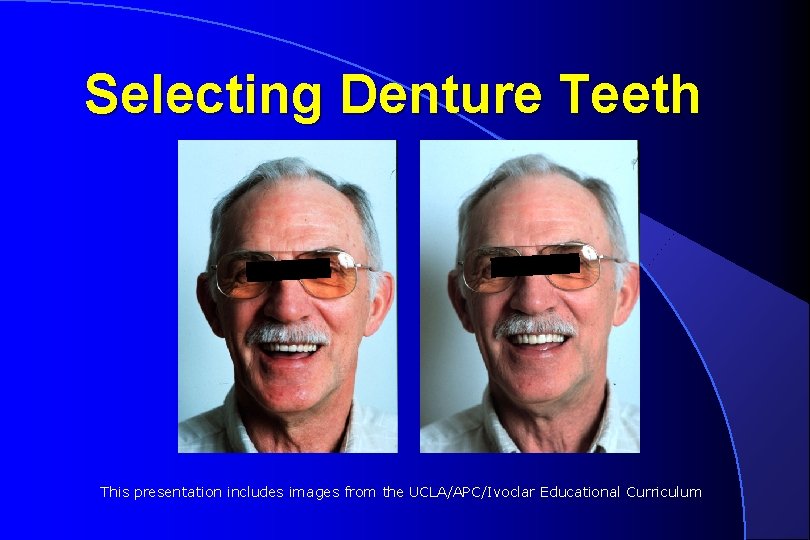 Selecting Denture Teeth This presentation includes images from the UCLA/APC/Ivoclar Educational Curriculum 