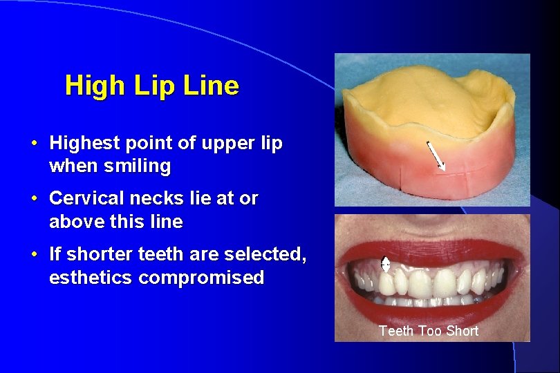 High Lip Line • Highest point of upper lip when smiling • Cervical necks