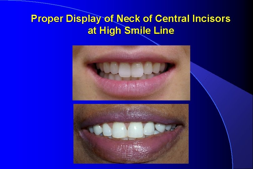 Proper Display of Neck of Central Incisors at High Smile Line 