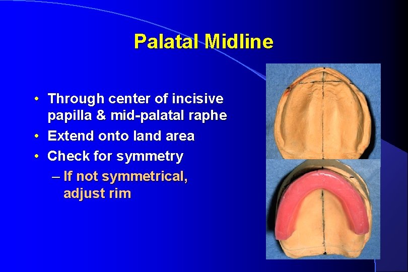 Palatal Midline • Through center of incisive papilla & mid-palatal raphe • Extend onto
