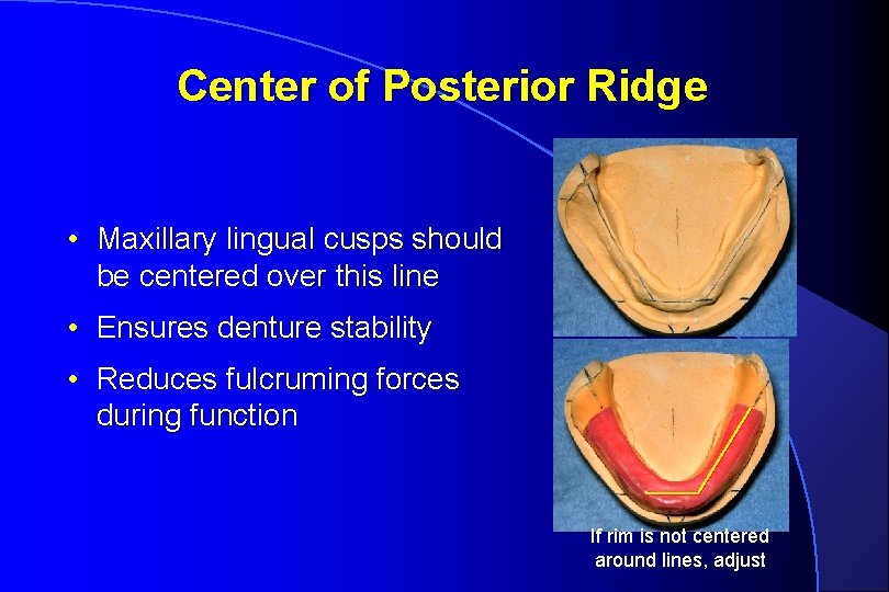 Center of Posterior Ridge • Maxillary lingual cusps should be centered over this line
