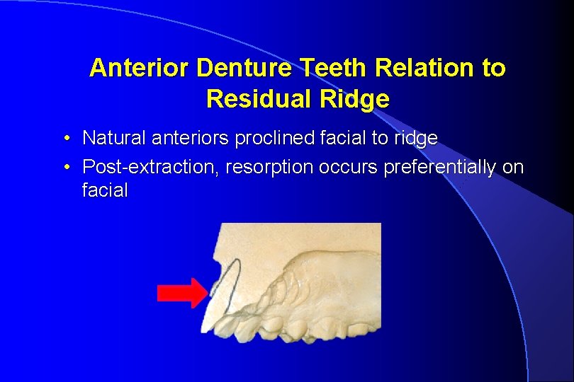 Anterior Denture Teeth Relation to Residual Ridge • Natural anteriors proclined facial to ridge