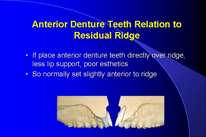 Anterior Denture Teeth Relation to Residual Ridge • If place anterior denture teeth directly