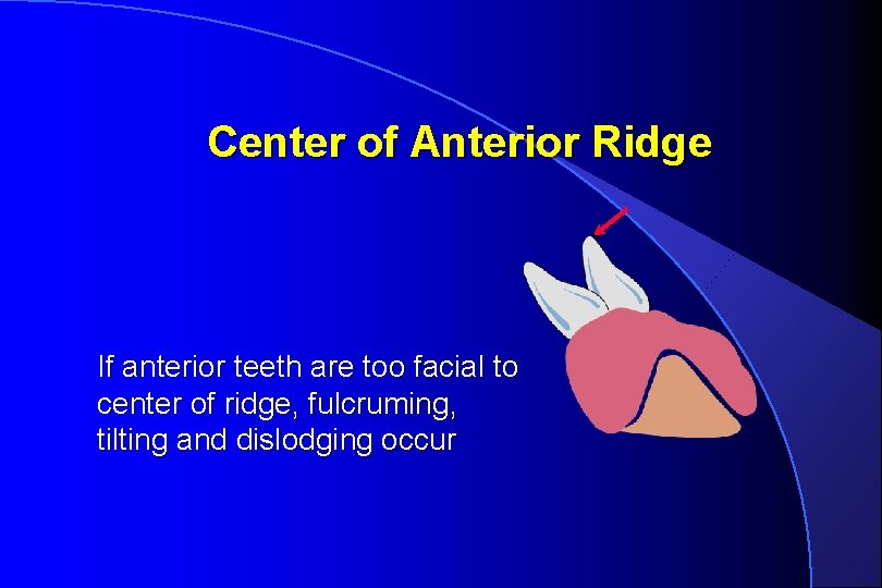 Center of Anterior Ridge If anterior teeth are too facial to center of ridge,