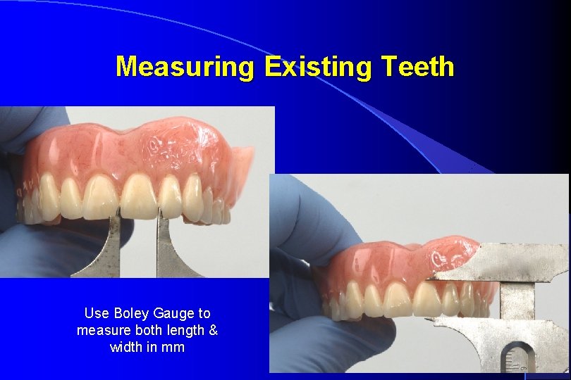 Measuring Existing Teeth Use Boley Gauge to measure both length & width in mm