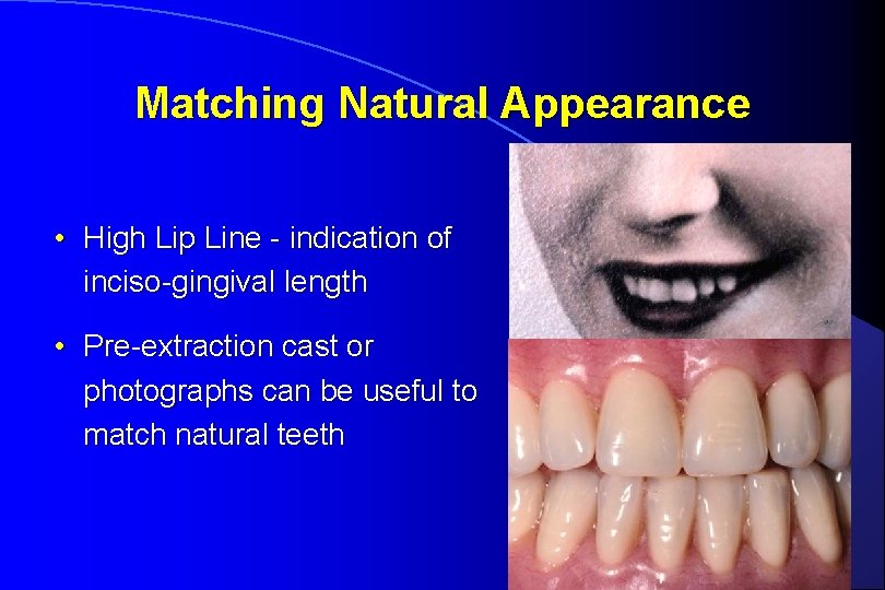 Matching Natural Appearance • High Lip Line - indication of inciso-gingival length • Pre-extraction