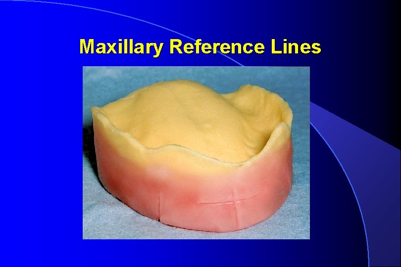 Maxillary Reference Lines 