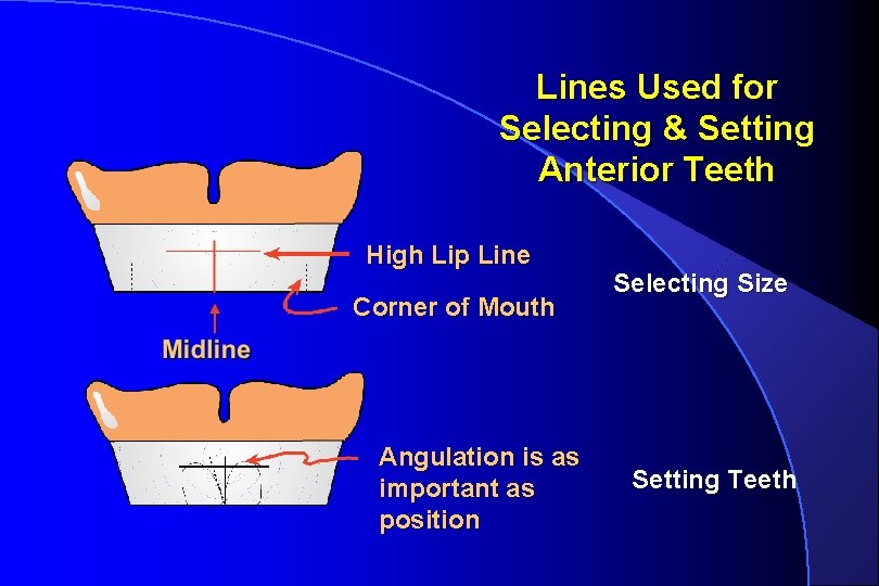 Lines Used for Selecting & Setting Anterior Teeth High Lip Line Corner of Mouth