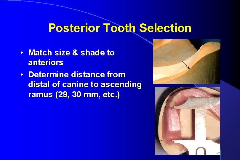 Posterior Tooth Selection • Match size & shade to anteriors • Determine distance from