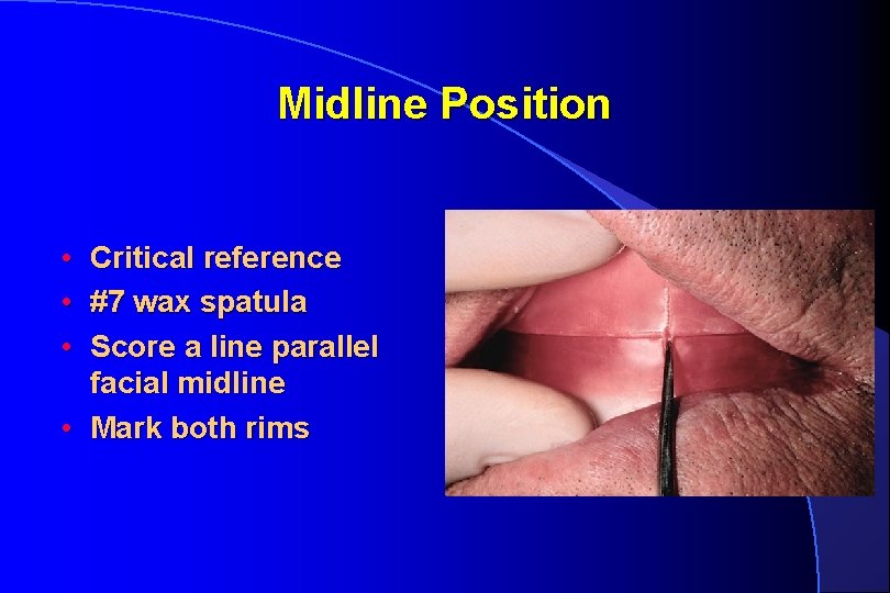 Midline Position • Critical reference • #7 wax spatula • Score a line parallel