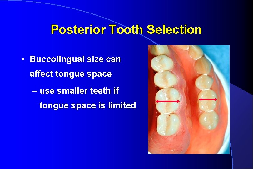 Posterior Tooth Selection • Buccolingual size can affect tongue space – use smaller teeth