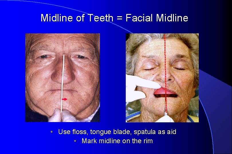 Midline of Teeth = Facial Midline • Use floss, tongue blade, spatula as aid