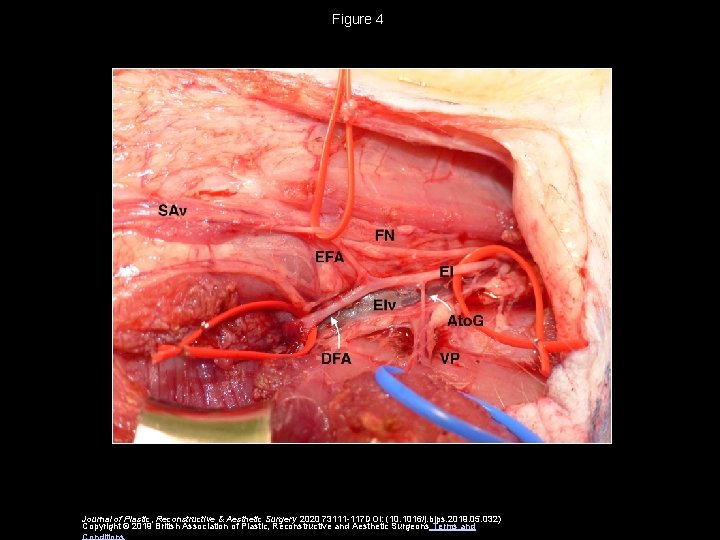 Figure 4 Journal of Plastic, Reconstructive & Aesthetic Surgery 2020 73111 -117 DOI: (10.