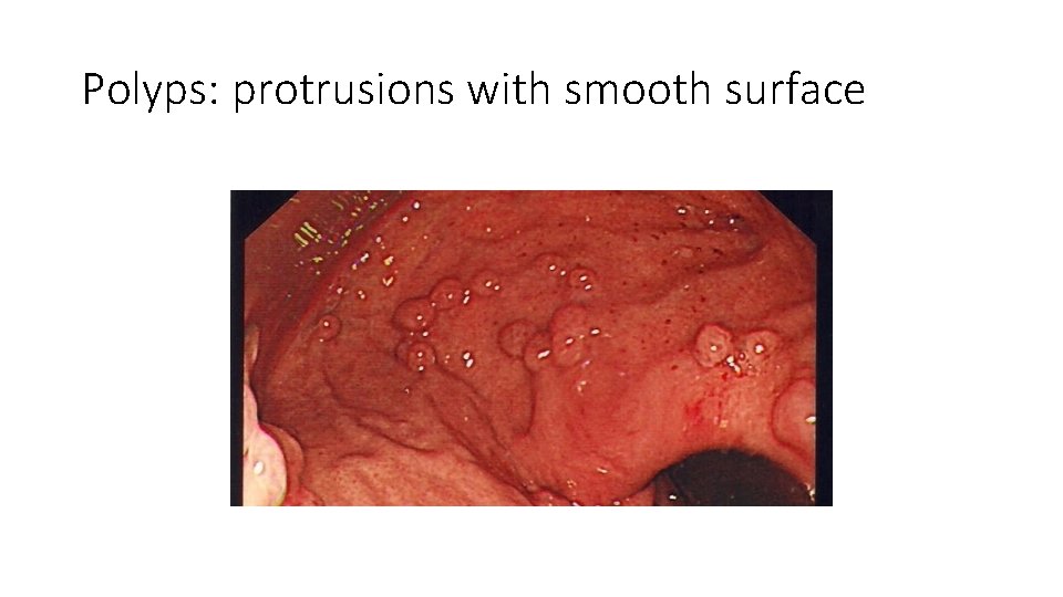 Polyps: protrusions with smooth surface 