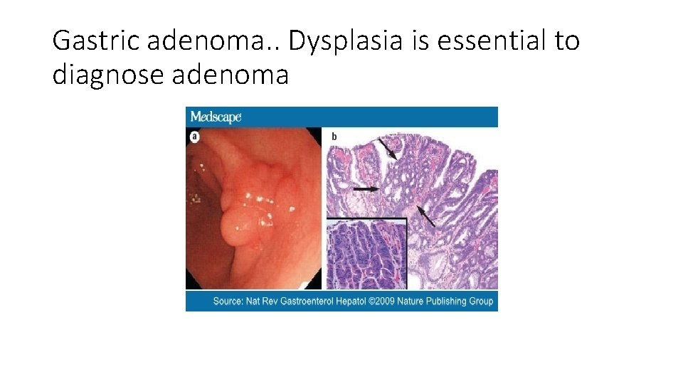 Gastric adenoma. . Dysplasia is essential to diagnose adenoma 