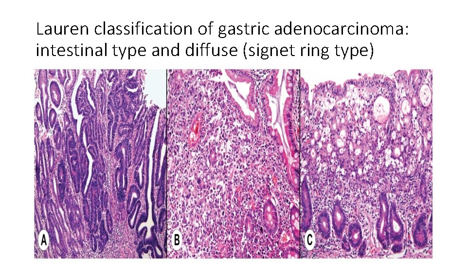 Lauren classification of gastric adenocarcinoma: intestinal type and diffuse (signet ring type) 