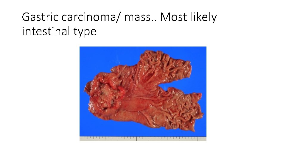 Gastric carcinoma/ mass. . Most likely intestinal type 