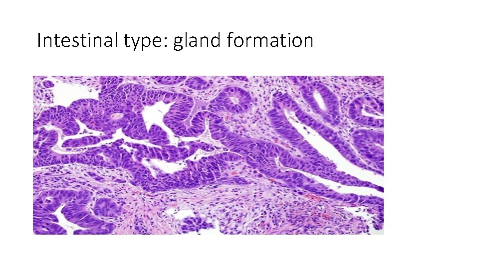 Intestinal type: gland formation 