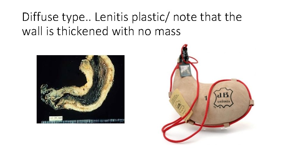 Diffuse type. . Lenitis plastic/ note that the wall is thickened with no mass