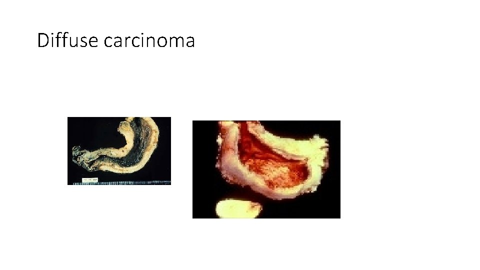 Diffuse carcinoma 