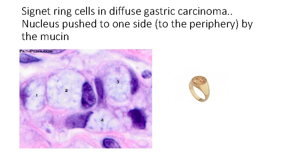 Signet ring cells in diffuse gastric carcinoma. . Nucleus pushed to one side (to