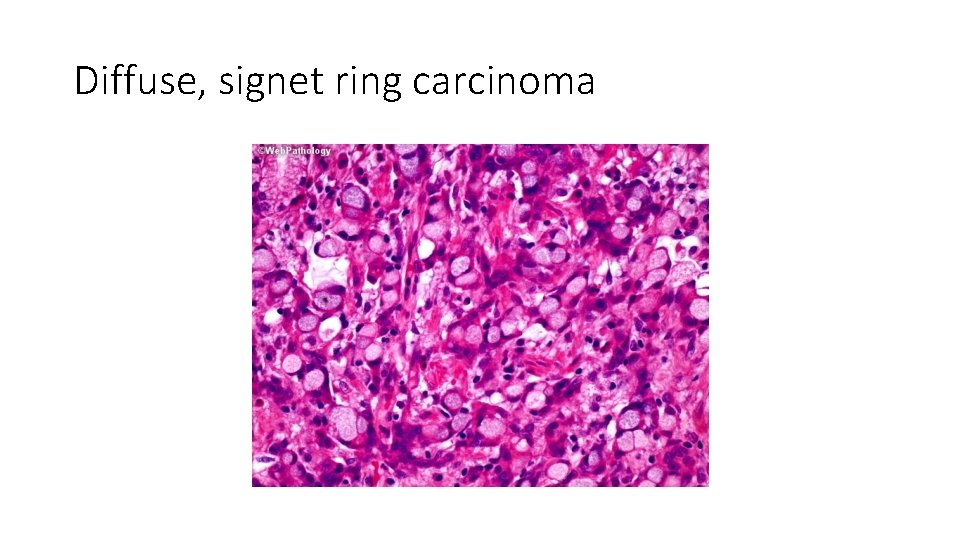Diffuse, signet ring carcinoma 