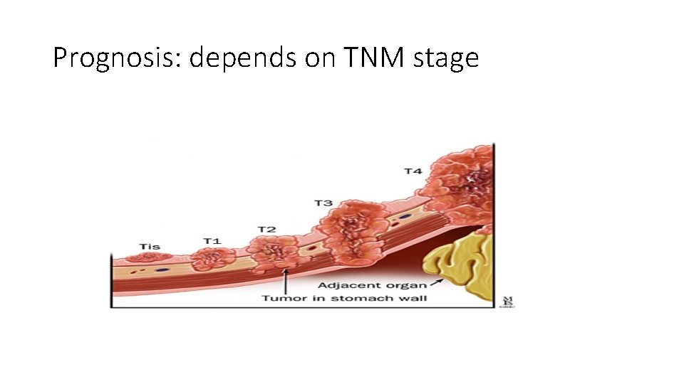 Prognosis: depends on TNM stage 